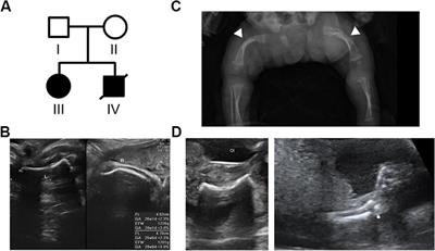 Novel Compound Heterozygous Mutations in CRTAP Cause Rare Autosomal Recessive Osteogenesis Imperfecta